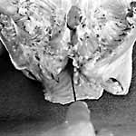 cut neck skin flap